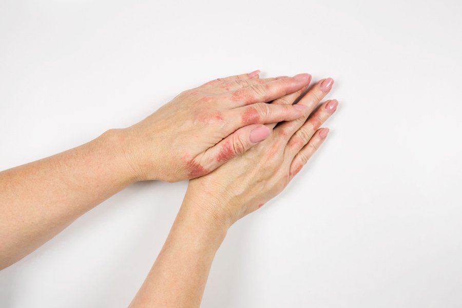 Can Light Therapy Help Treat Eczema?