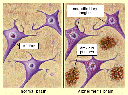 Alzheimer's diagram - amyloid plaques and neurofibrillary tangles are present in a brain with Alzheimer's.